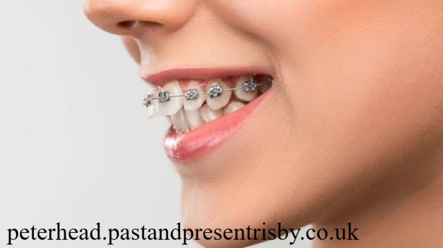 4 Cara Ampuh Memperbaiki Gigi Tonggos dengan Teknik Terbaik