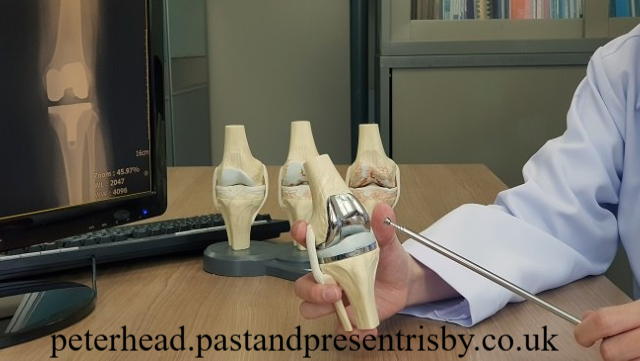 Panduan Lengkap Operasi Pengganti Lutut untuk Atasi Rasa Sakit